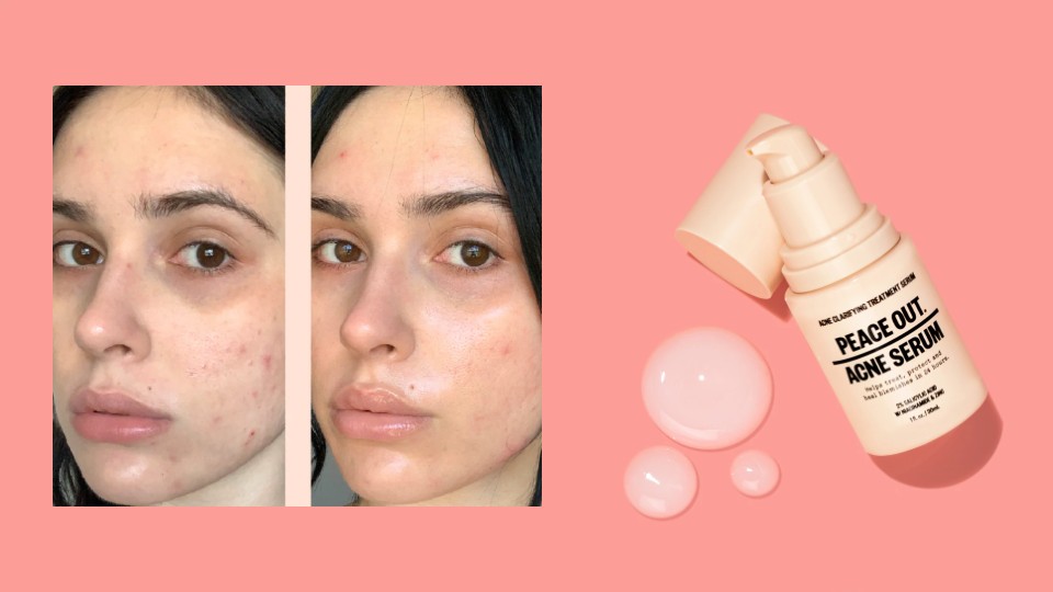 I Tested ‘The Holy Grail of Acne Serums’ & It Cleared Up My Face in a Week—Get It For 35% Off