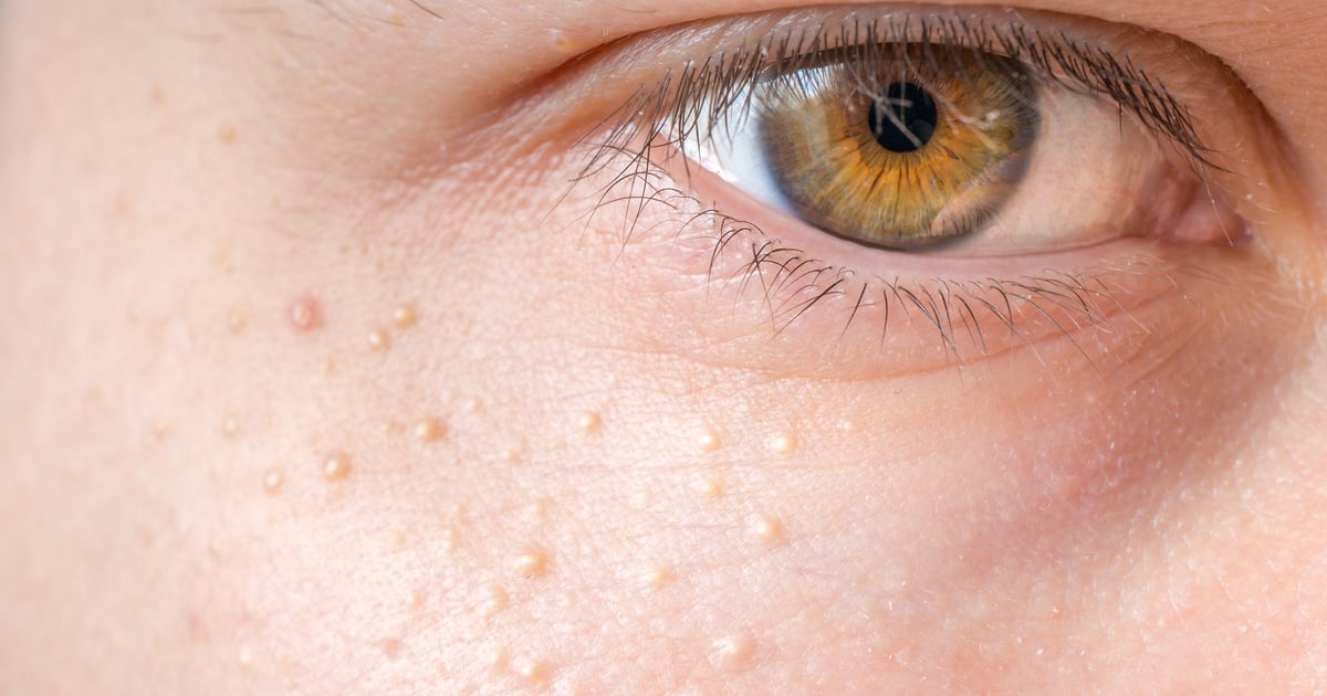 Comment supprimer Milia |  POPSUGAR Beauté Royaume-Uni
