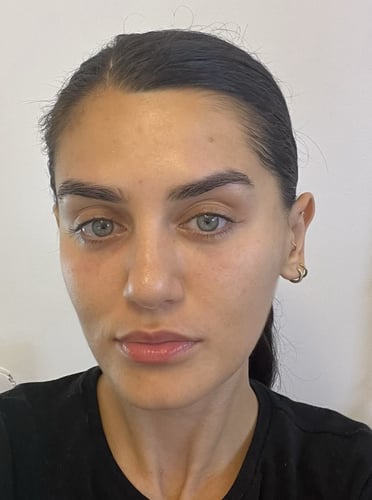 Ma peau après avoir utilisé le sérum à l'acide mandélique The Ordinary