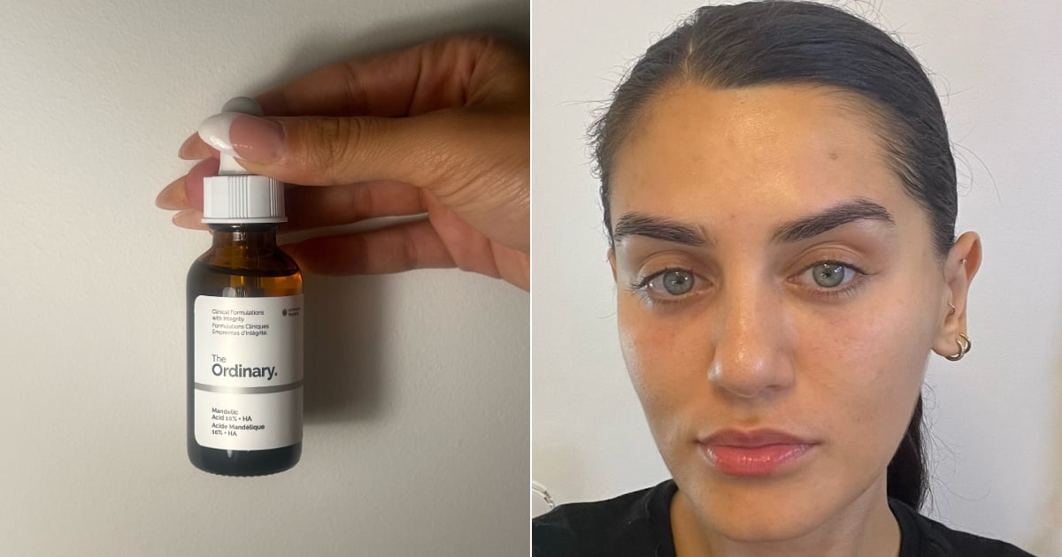 L'examen ordinaire du sérum à l'acide mandélique avec photos
