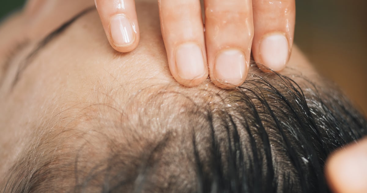 Craquage des cheveux : à propos de la tendance dangereuse des éclats de cuir chevelu