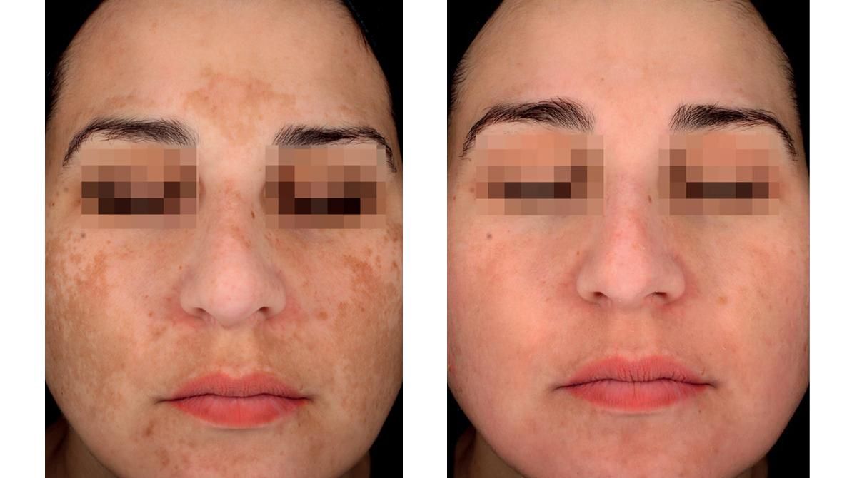 La piel antes y después del tratamiento despigmentante cosmelan® de mesoestetic®