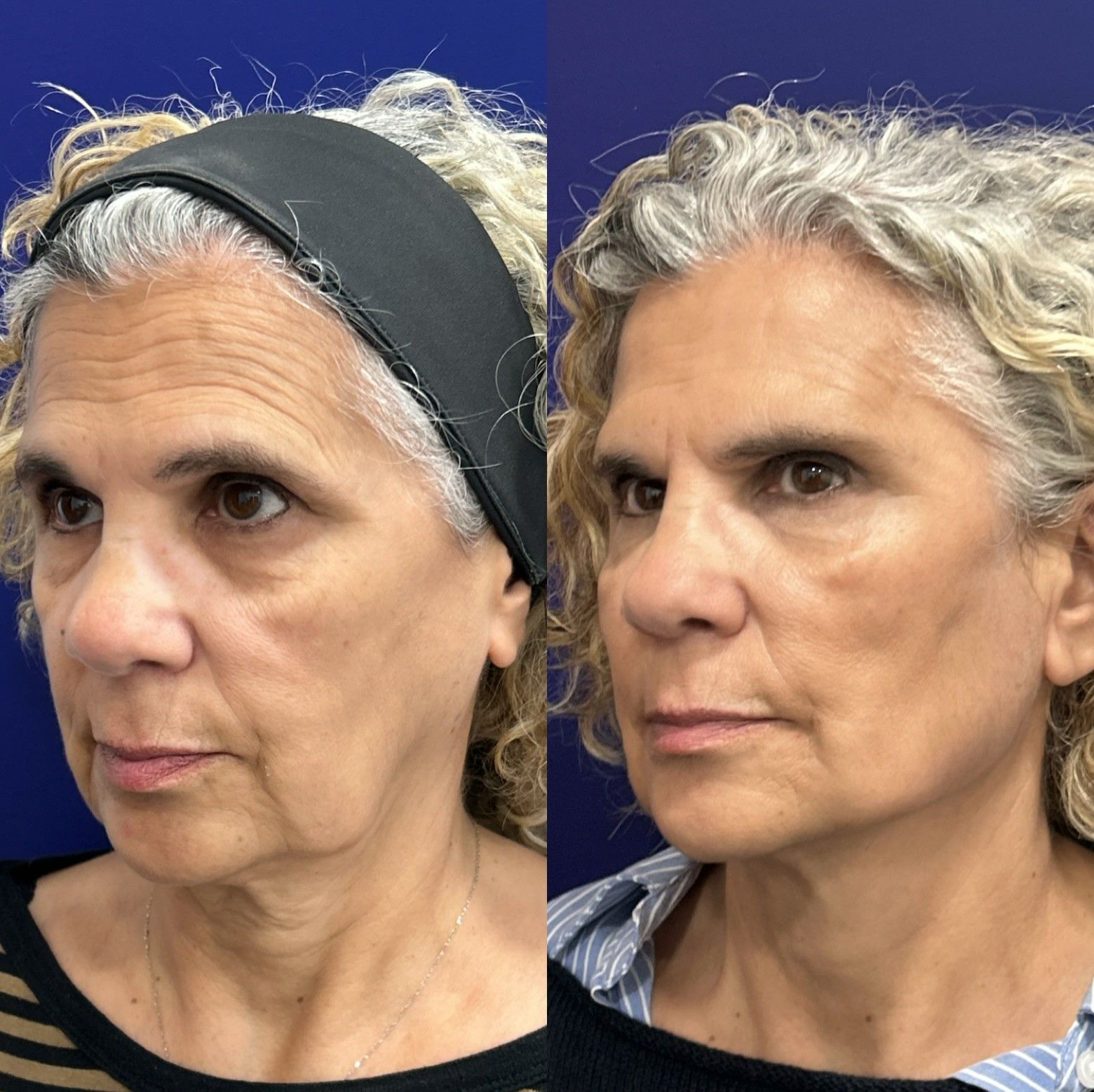 Avant et après Global Face