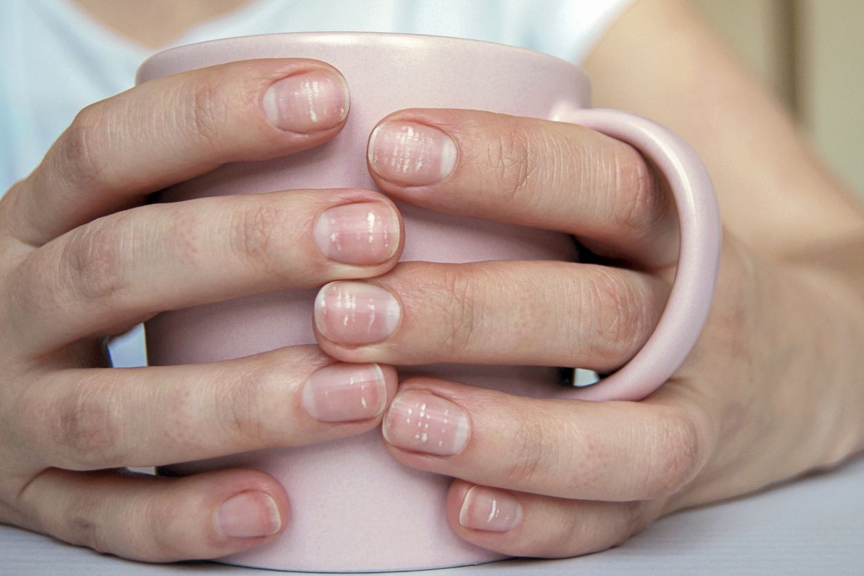 Las uñas estriadas pueden ser un signo claro de deshidratación y desnutrición.