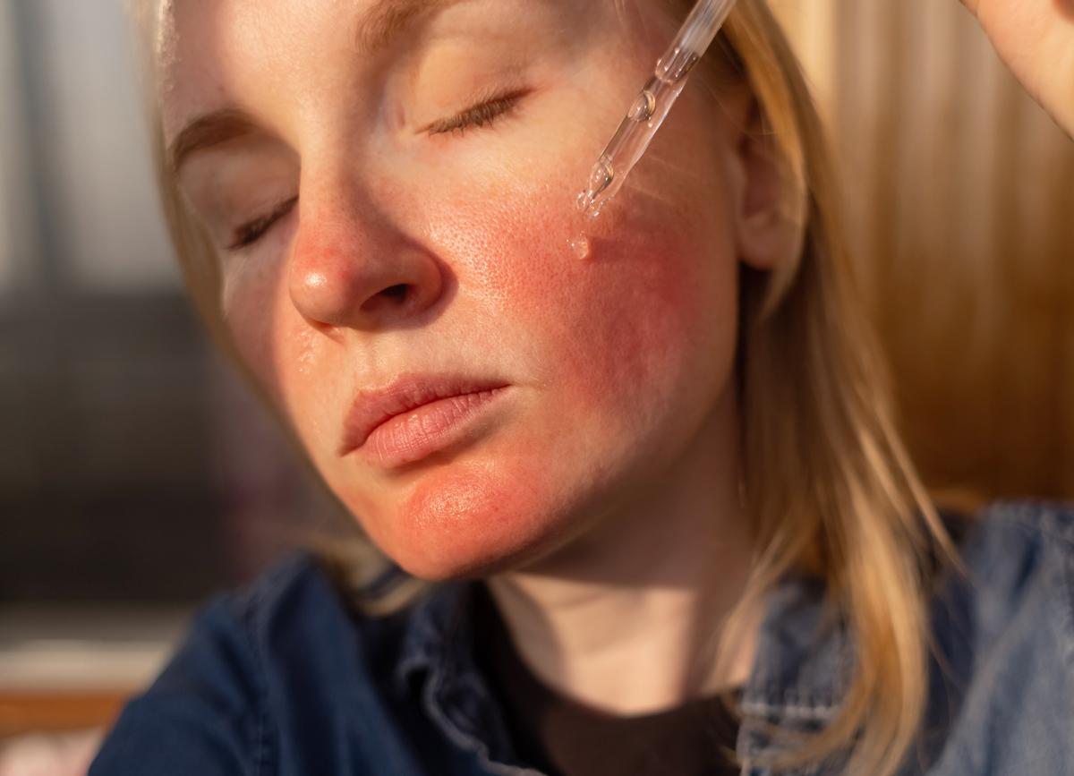 Visage atteint de rosacée