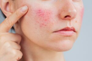 PEAU ROSACÉE | 5 recommandations clés pour les soins de la peau souffrant de rosacée selon la pharmacienne Maria Jesús Vergara