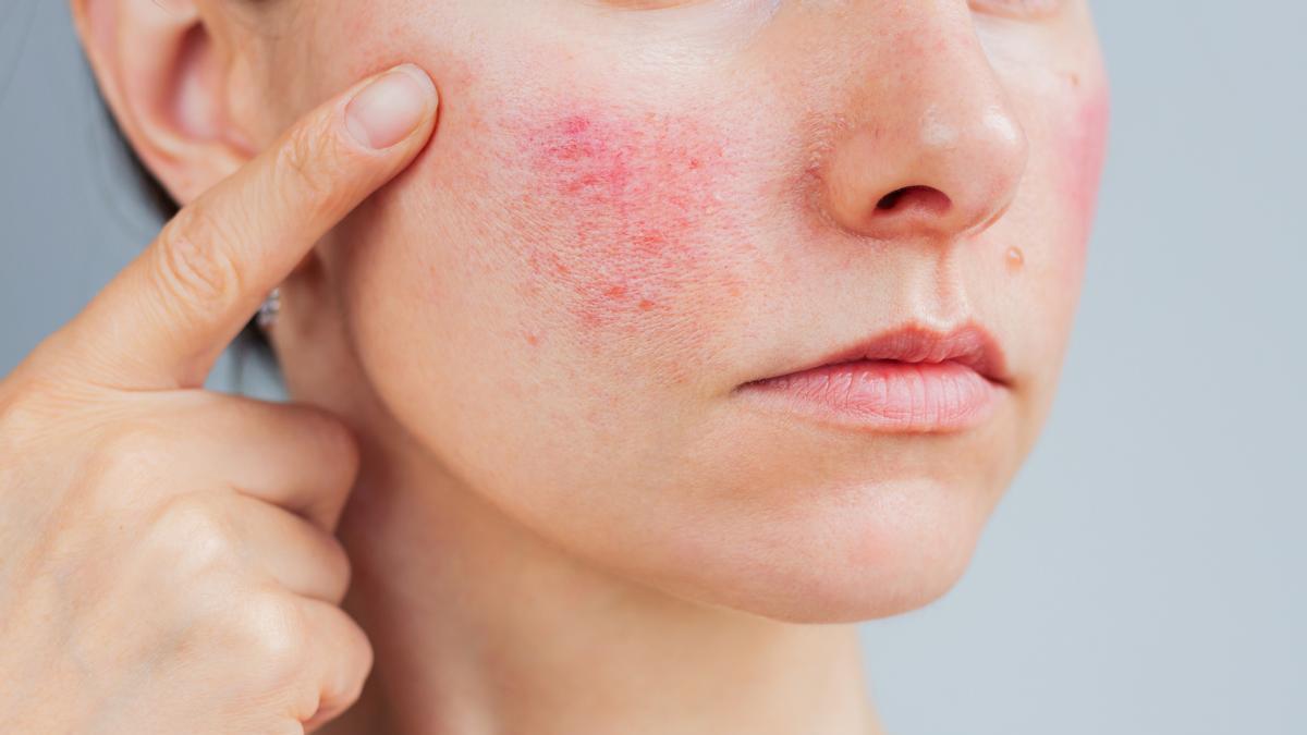 5 recomendaciones clave para el cuidado de la piel con rosácea según la farmacéutica Maria Jesús Vergara