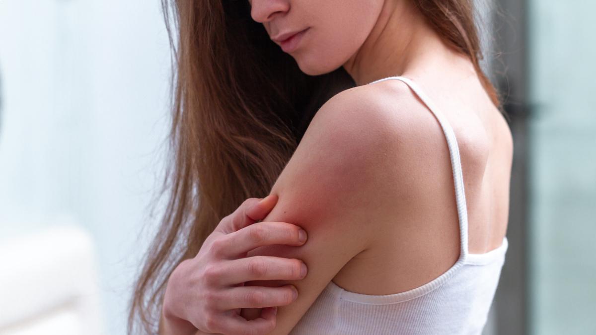 Los mejores productos para aliviar el picor e irritación de los granos