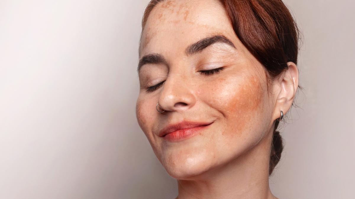 Así es como debes cuidar tu piel ante el sol si tienes melasma