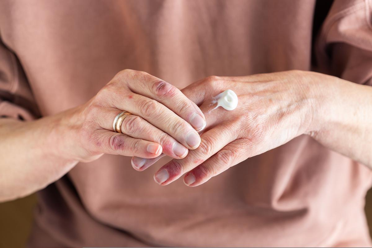 Peau avec dermatite sur les mains