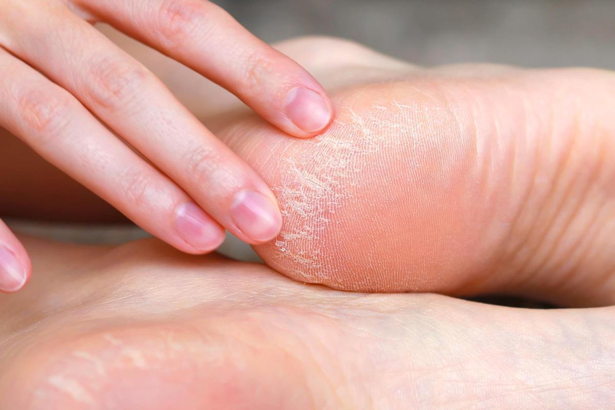 pieds fissurés
