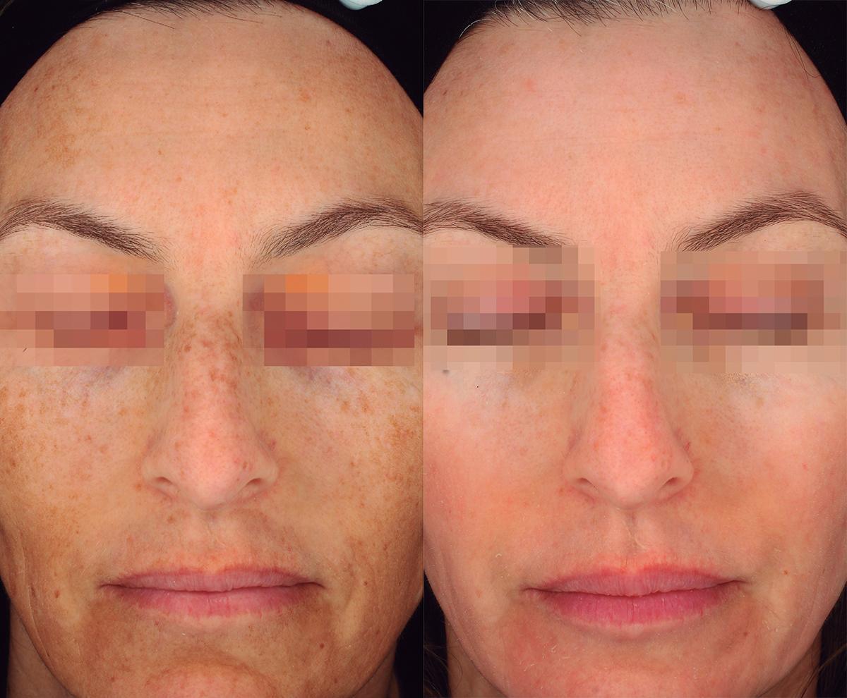 Patient avant et après utilisation de cosmelan®, la méthode professionnelle de dépigmentation de mesoestetic®.